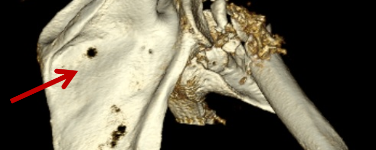 Infraspinous Fossa