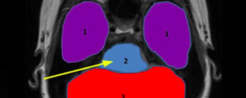 Midbrain